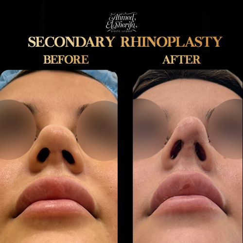 تكلفة تجميل الأنف مع تصحيح الحاجز الأنفي